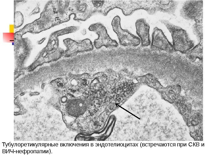 Тубулоретикулярные включения в эндотелиоцитах (встречаются при СКВ и ВИЧ-нефропатии ).  