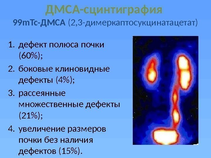 ДМСА-сцинтиграфия  99 m. Тс-ДМСА (2, 3 -димеркаптосукцинатацетат) 1. дефект полюса почки (60); 2.