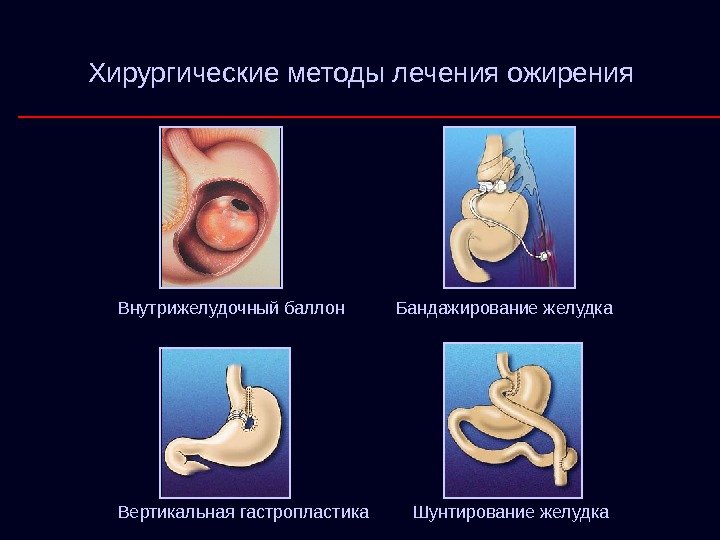   Хирургические методы лечения ожирения Внутрижелудочный баллон Бандажирование желудка Вертикальная гастропластика Шунтирование желудка