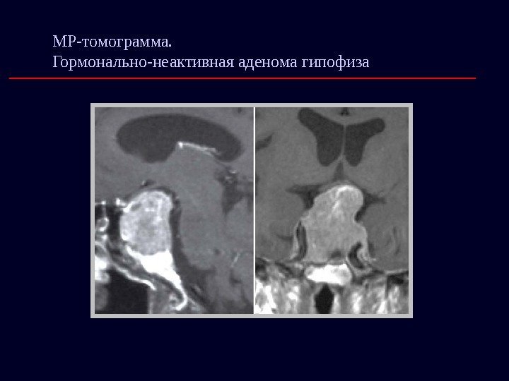 МР-томограмма.  Гормонально-неактивная аденома гипофиза 
