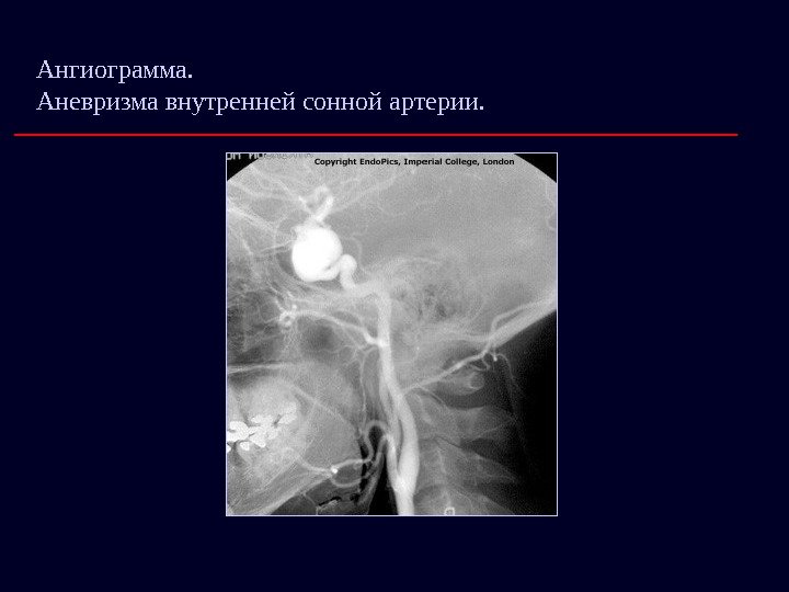 Ангиограмма.     Аневризма внутренней сонной артерии. 