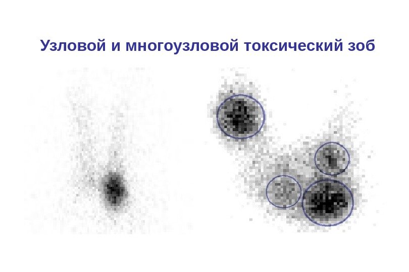 Узловой и многоузловой токсический зоб 