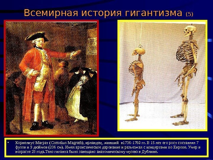  Всемирная история гигантизма (5) • Корнелиус Маграт ( Cornelius Magrath) , ирландец, живший