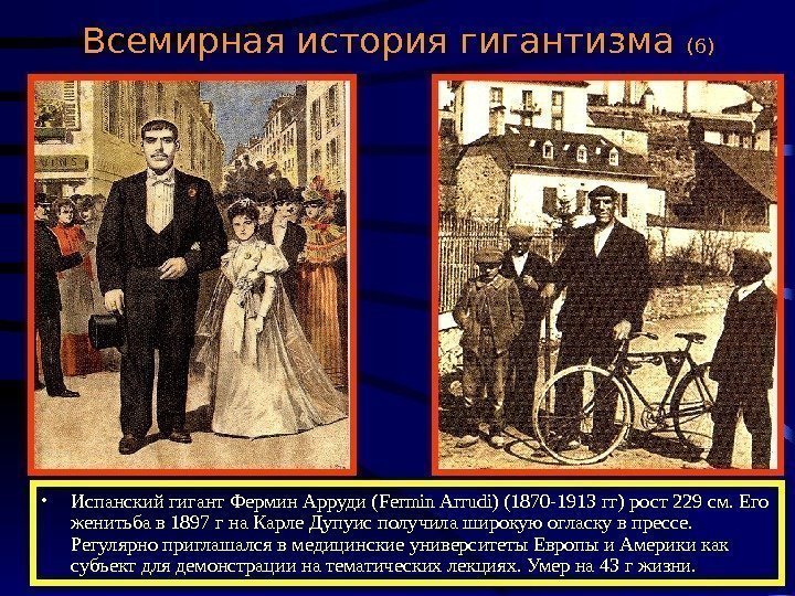  Всемирная история гигантизма (6) • Испанский гигант Фермин Арруди ( Fermin Arrudi) (1870