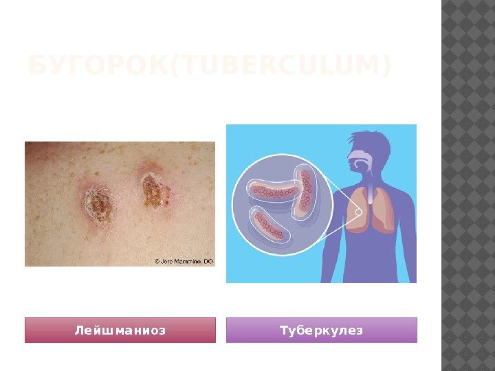 БУГОРОК(TUBERCULUM) Лейшманиоз Туберкулез 1 B 03 
