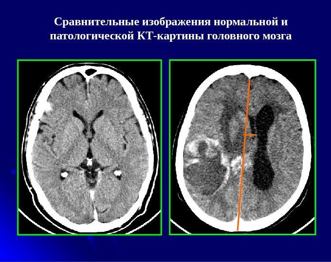 Сравнительные изображения нормальной и патологической КТ-картины головного мозга 