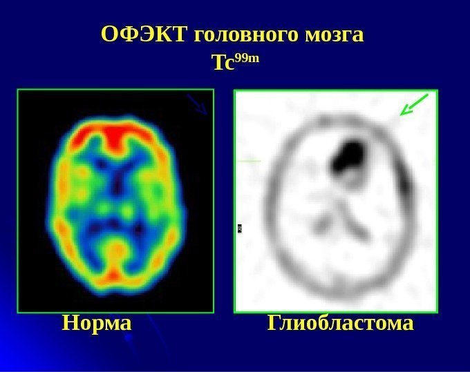 ОФЭКТ головного мозга Tc 99 m Норма    Глиобластома 