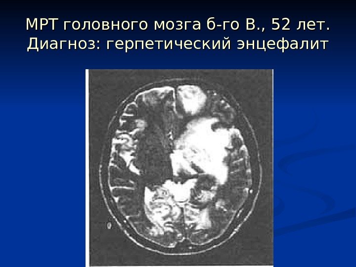 МРТ головного мозга б-го В. , 52 лет.  Диагноз: герпетический энцефалит 