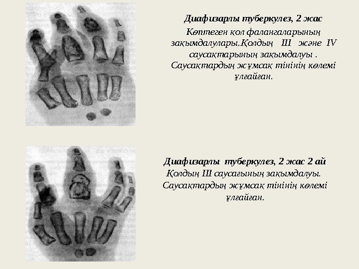 Диафизарлы туберкулез, 2 жас К птеген ол фалангаларыны ө қ ң за ымдалулары. қ