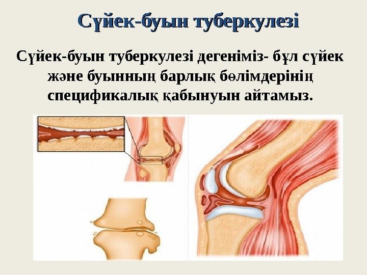 С йек-буын туберкулезіү С йек-буын туберкулезі дегеніміз- б л с йек ү ұ ү