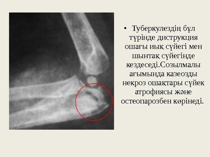  • Туберкулезді б л ң ұ т рінде диструкция ү оша ы иы