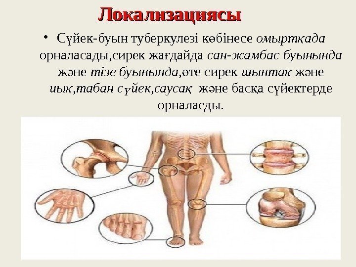 Локализациясы • С йек-буын туберкулезі к бінесе ү ө омырт ада қ орналасады, сирек