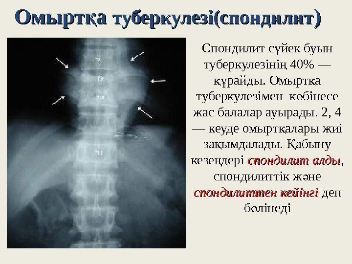 Омырт а қ туберкулезі(спондилит )) Спондилит с йек буын ү туберкулезіні 40 — ң