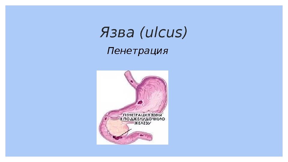 Язва (ulcus) Пенетрация 
