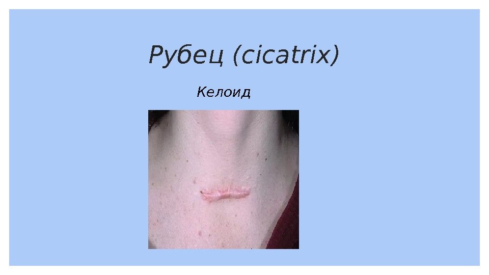 Рубец (cicatrix) Келоид 