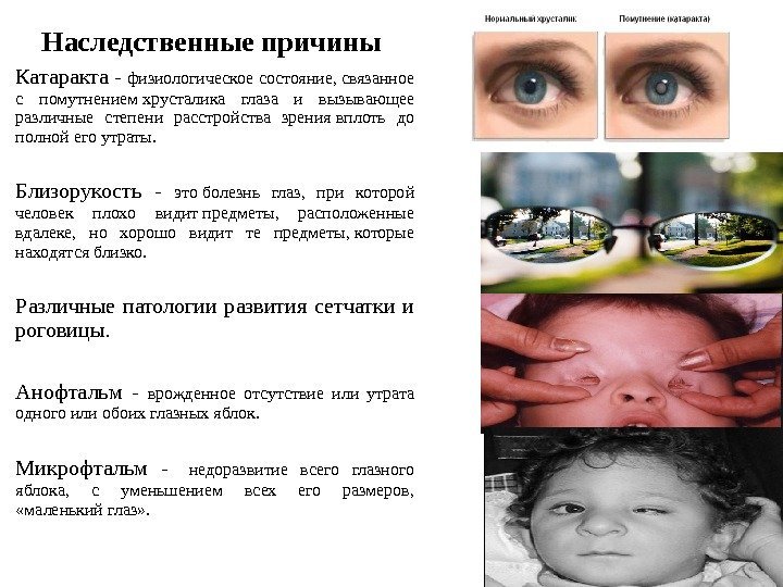    Наследственные причины Катаракта - физиологическое состояние, связанное с помутнением хрусталика глаза