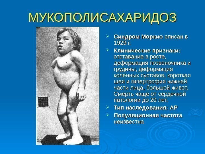 МУКОПОЛИСАХАРИДОЗ Синдром Моркио описан в 1929 г.  Клинические признаки: отставание в росте, 