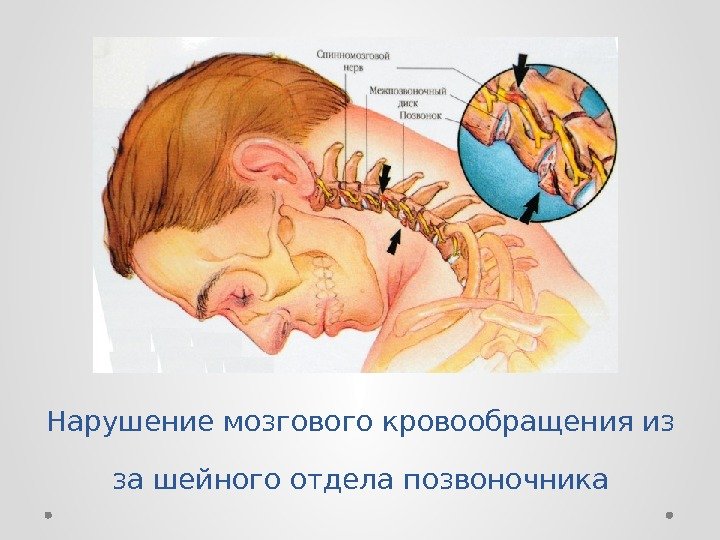 Нарушение мозгового кровообращения из за шейного отдела позвоночника 