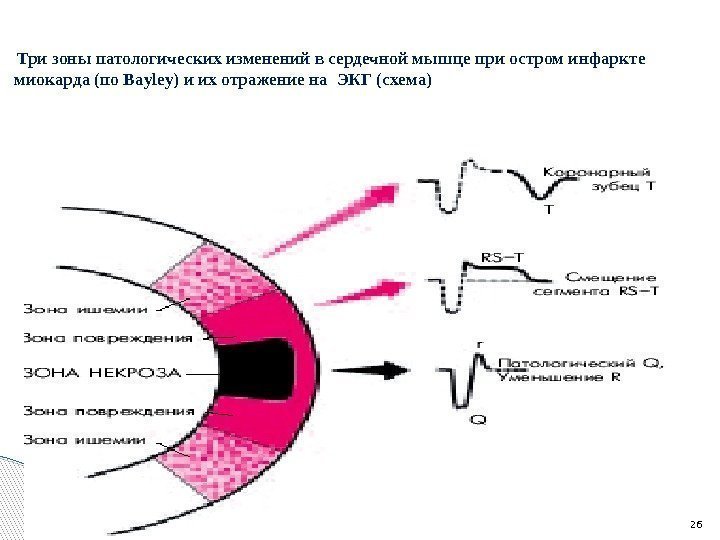  Три зоны патологических изменений в сердечной мышце при остром инфаркте миокарда (по Bayley)