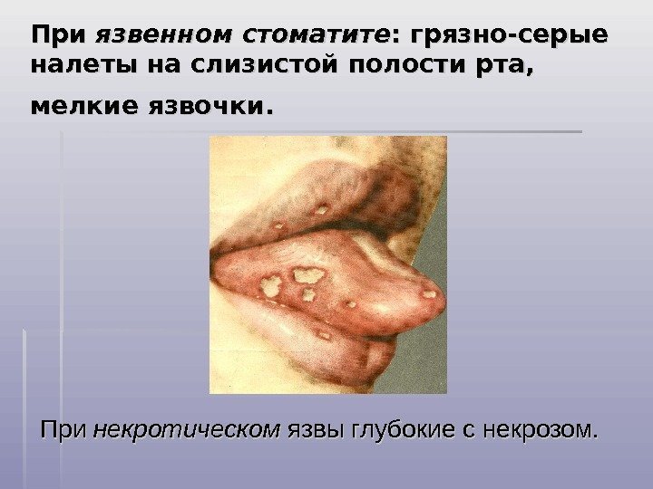 При язвенном  стоматите : грязно-серые налеты на слизистой полости рта,  мелкие язвочки.