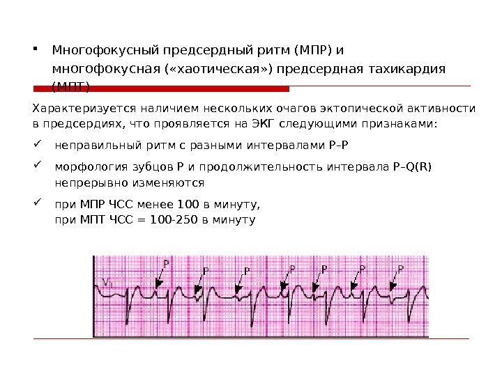 Характеризуется наличием нескольких очагов эктопической активности впредсердиях, что проявляется на ЭКГ следующими признаками: 