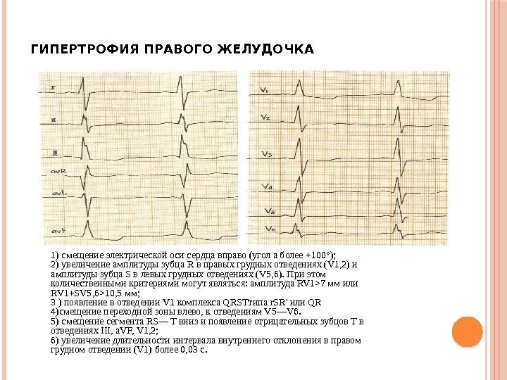 ГИПЕРТРОФИЯ ПРАВОГО ЖЕЛУДОЧКА 1) смещение электрической оси сердца вправо (угол а более +100°); 2)
