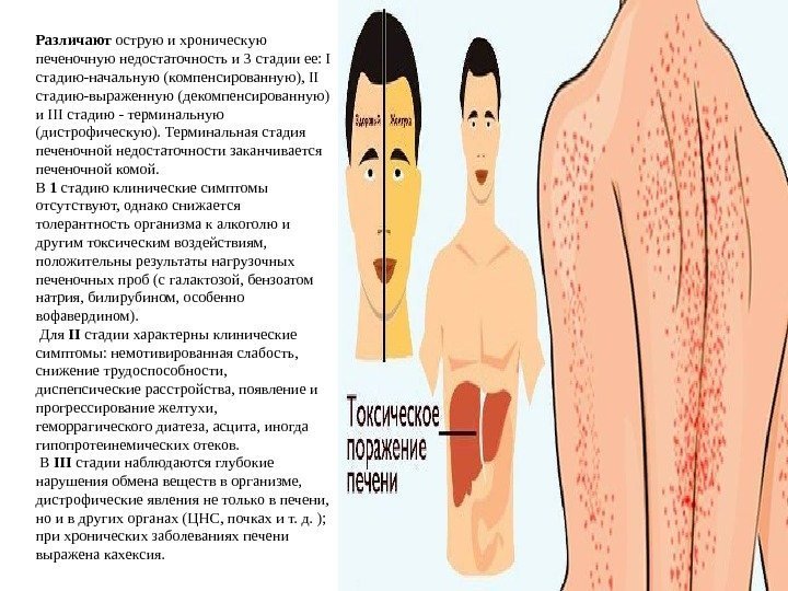 Различают острую и хроническую печеночную недостаточность и 3 стадии ее: I стадию-начальную (компенсированную), II