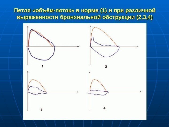 Петля «объём-поток» в норме (1) и при различной выраженности бронхиальной обструкции (2, 3, 4)