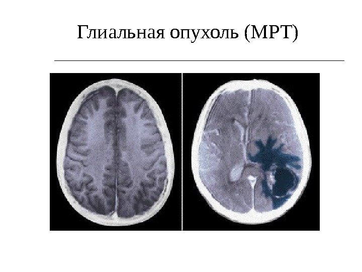 Глиальная опухоль (МРТ) 