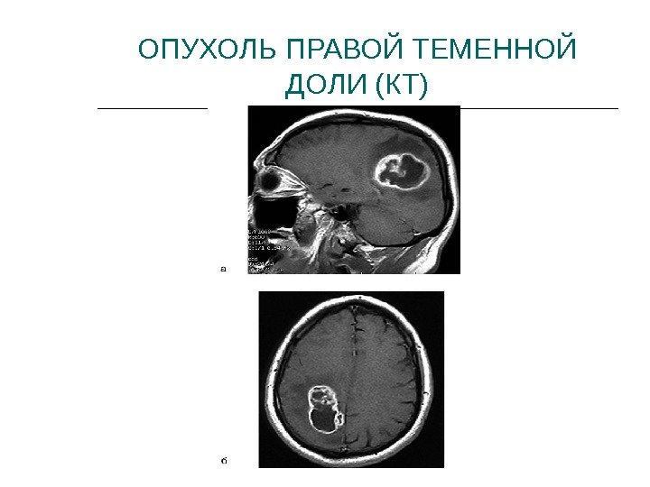 ОПУХОЛЬ ПРАВОЙ ТЕМЕННОЙ ДОЛИ (КТ) 