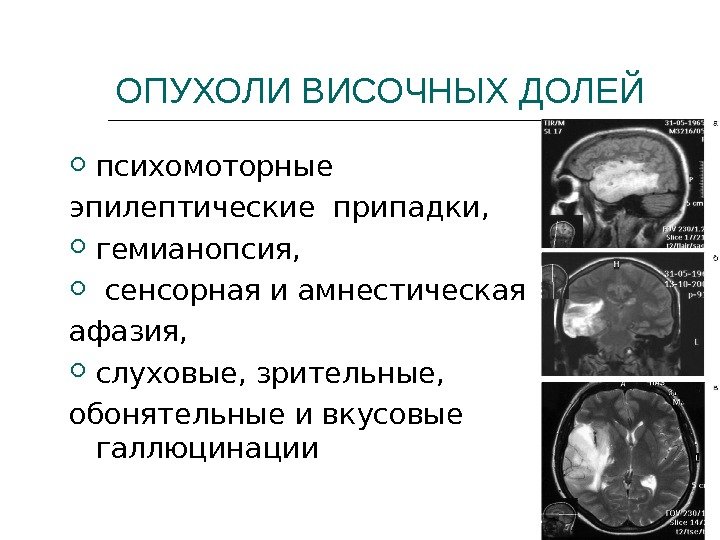 ОПУХОЛИ ВИСОЧНЫХ ДОЛЕЙ психомоторные  эпилептические припадки, гемианопсия, сенсорная и амнестическая афазия,  слуховые,