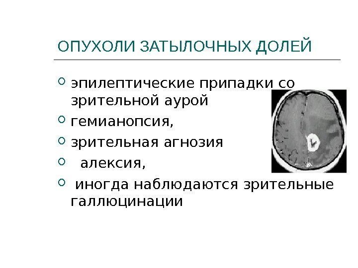 ОПУХОЛИ ЗАТЫЛОЧНЫХ ДОЛЕЙ эпилептические припадки со зрительной аурой  гемианопсия,  зрительная агнозия алексия,