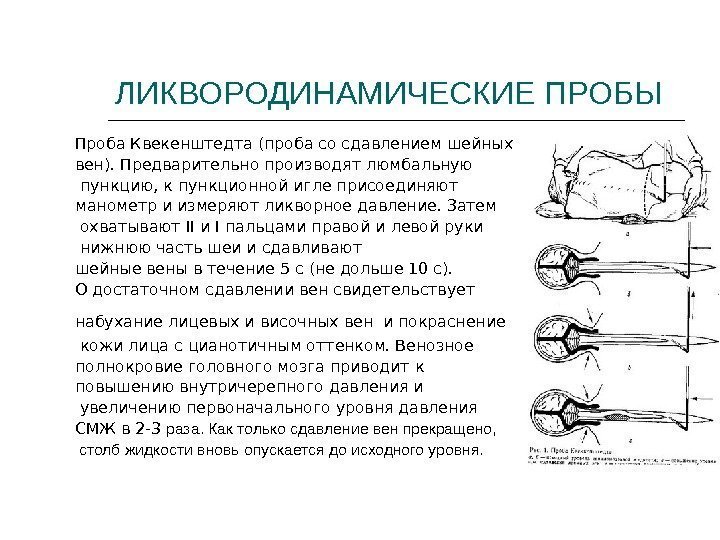 ЛИКВОРОДИНАМИЧЕСКИЕ ПРОБЫ Проба Квекенштедта (проба со сдавлением шейных вен). Предварительно производят люмбальную  пункцию,