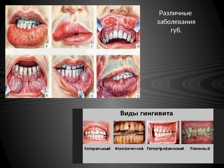 Различные заболевания губ. 