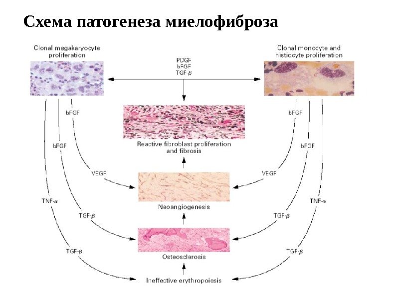 Схема патогенеза миелофиброза 