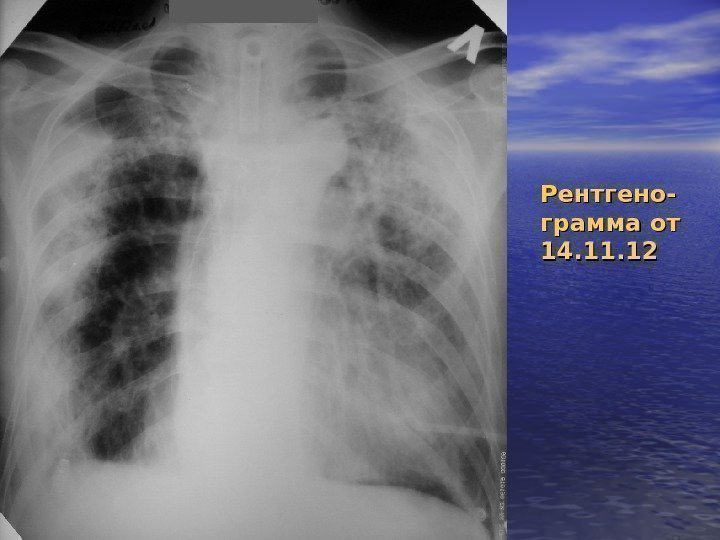 Рентгено- грамма от 14. 11. 12 