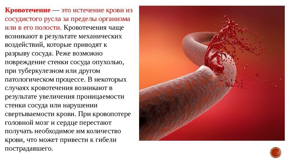 Кровотечение — это истечение крови из сосудистого русла за пределы организма или в его