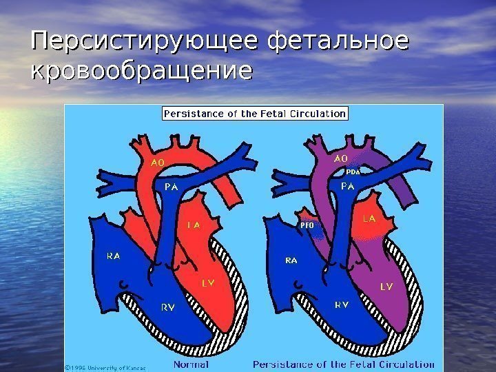 Персистирующее фетальное кровообращение 