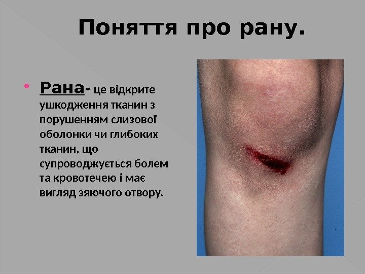 Поняття про рану.  Рана -  це відкрите ушкодження тканин з порушенням слизової