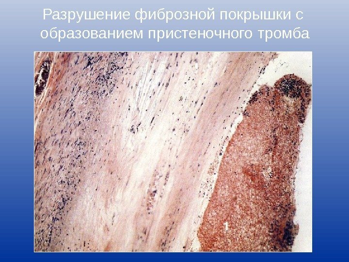 Разрушение фиброзной покрышки с образованием пристеночного тромба 