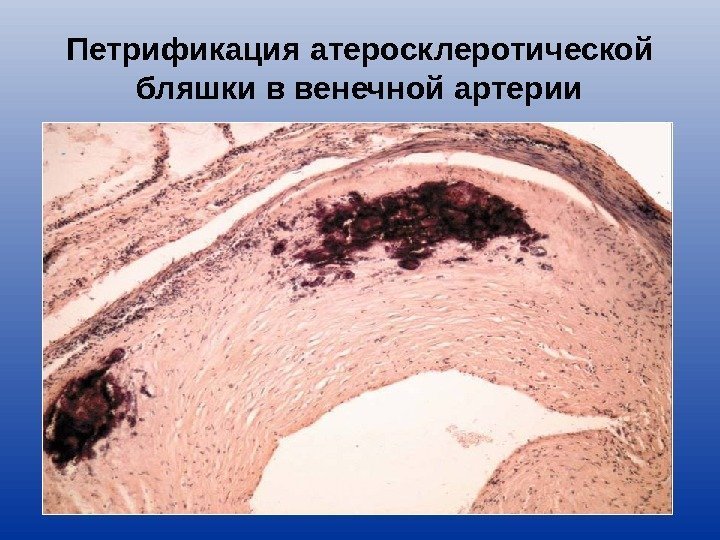 Петрификация атеросклеротической бляшки в венечной артерии 