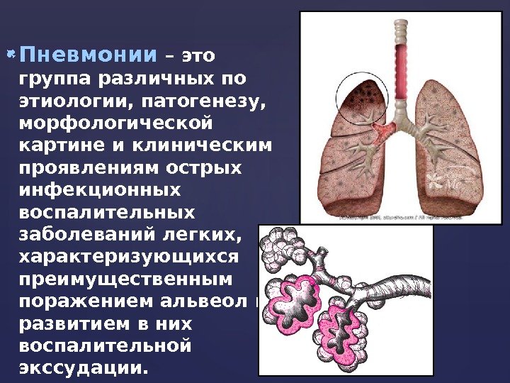  Пневмонии  – это группа различных по этиологии, патогенезу,  морфологической картине и