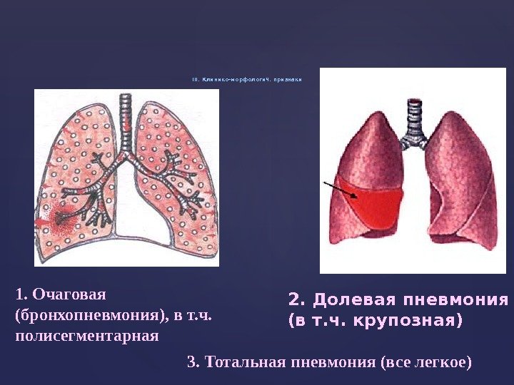 III. Клинико-морфологич. признаки 1. Очаговая (бронхопневмония), в т. ч.  полисегментарная 2. Долевая пневмония