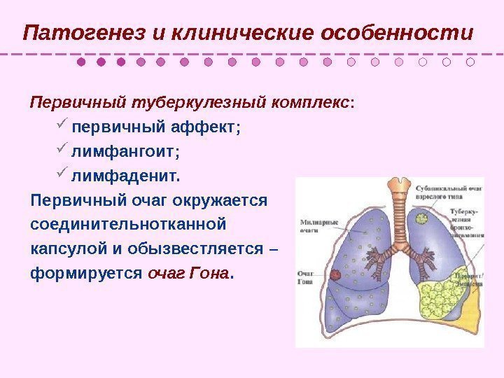   Патогенез и клинические особенности Первичный туберкулезный комплекс :  первичный аффект; 