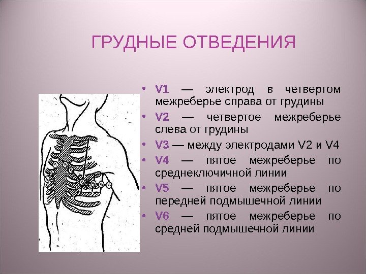 ГРУДНЫЕ ОТВЕДЕНИЯ • V 1  —  электрод  в четвертом межреберье справа