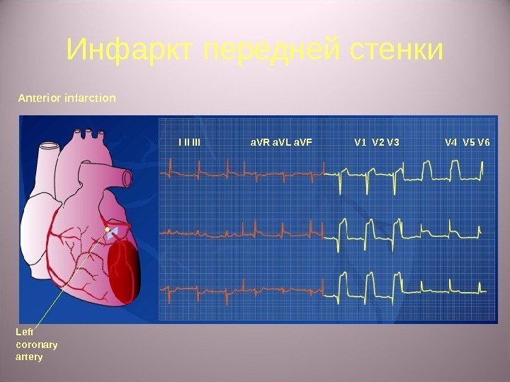 Инфаркт передней стенки Anterior infarction I II III a. VR a. VL a. VF
