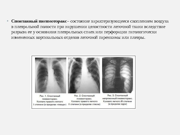  • Спонтанный пневмоторакс – состояние характеризующееся скоплением воздуха в плевральной полости при нарушении