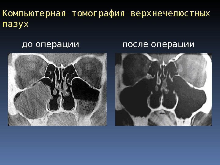 Компьютерная томография верхнечелюстных пазух до операции после операции 
