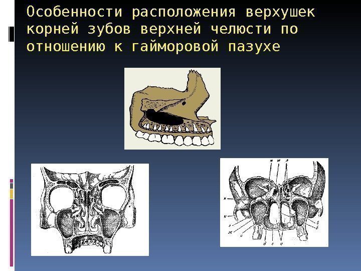 Особенности расположения верхушек корней зубов верхней челюсти по отношению к гайморовой пазухе 