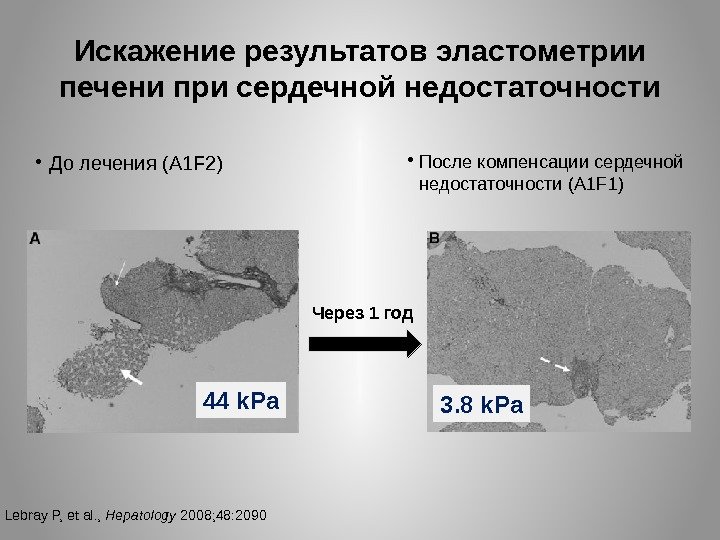 Искажение результатов эластометрии печени при сердечной недостаточности • До лечения (A 1 F 2)